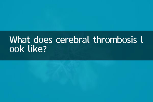 脳血栓症とはどのようなものですか?