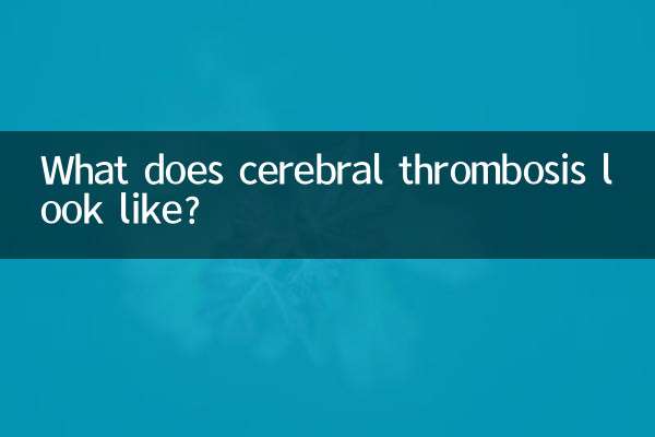 脳血栓症とはどのようなものですか?